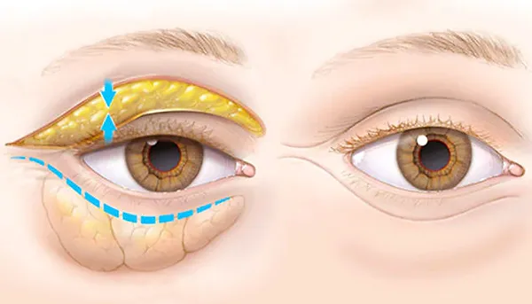 Blefaroplastica Napoli