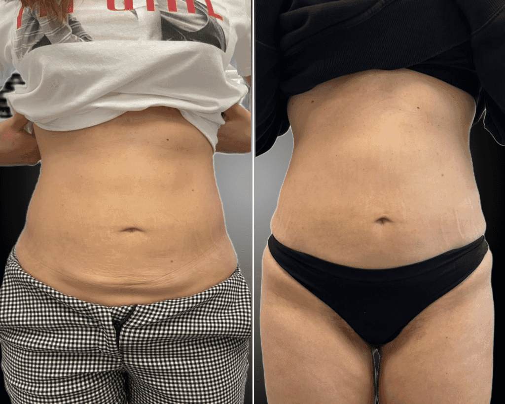 addominoplastica napoli