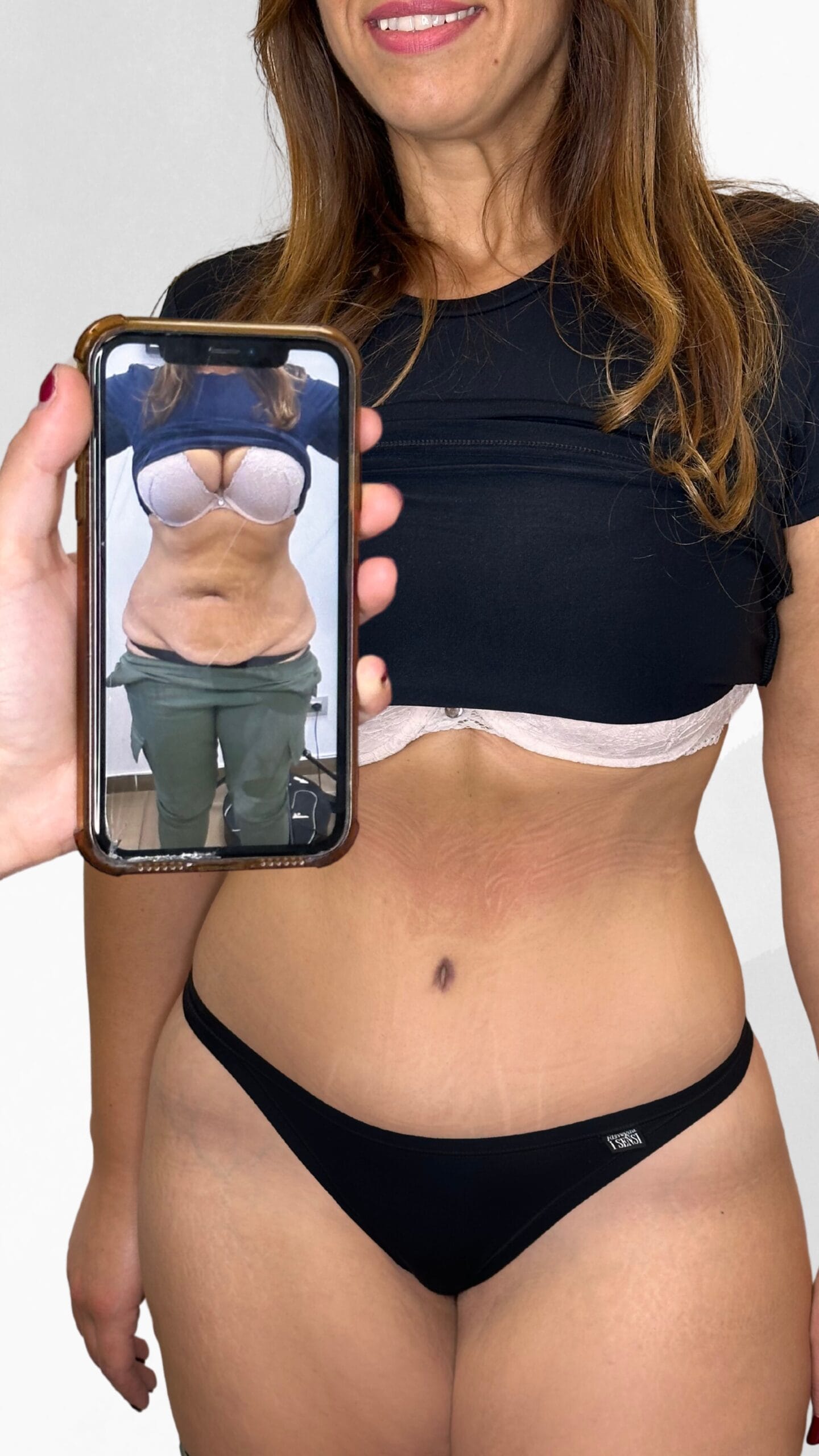 lipoaddominoplastica-dottor-giuseppe-scalera-napoli